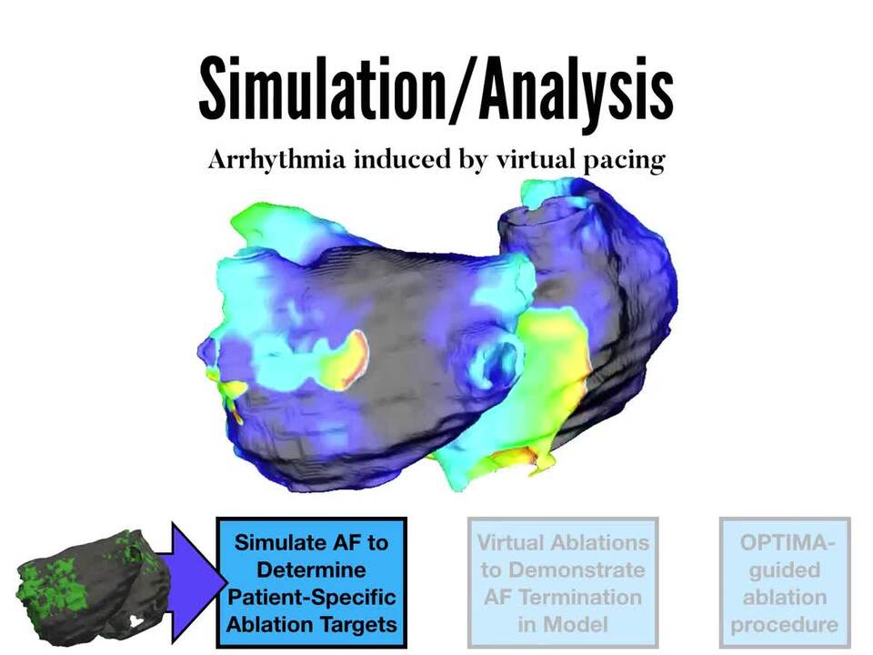 Simulations guide targeted ablation of atrial fibrillation – Physics World