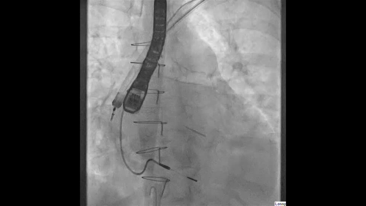 Transvenous lead extraction: Experience of the Tandem approach