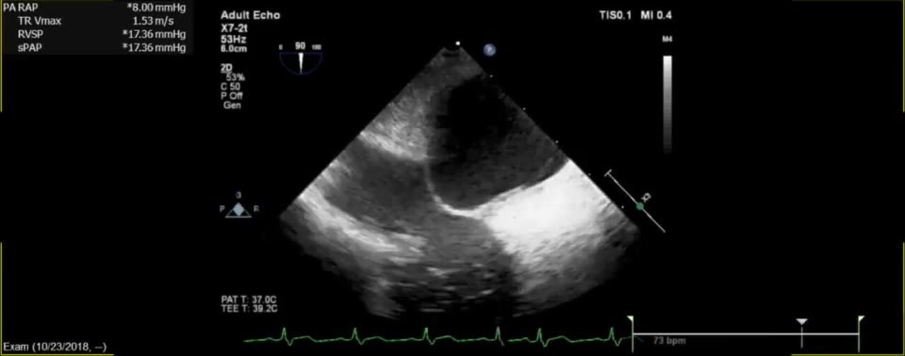 Efficacy of echocardiography for differential diagnosis of left ventricular  hypertrophy: special focus on speckle-tracking longitudinal strain