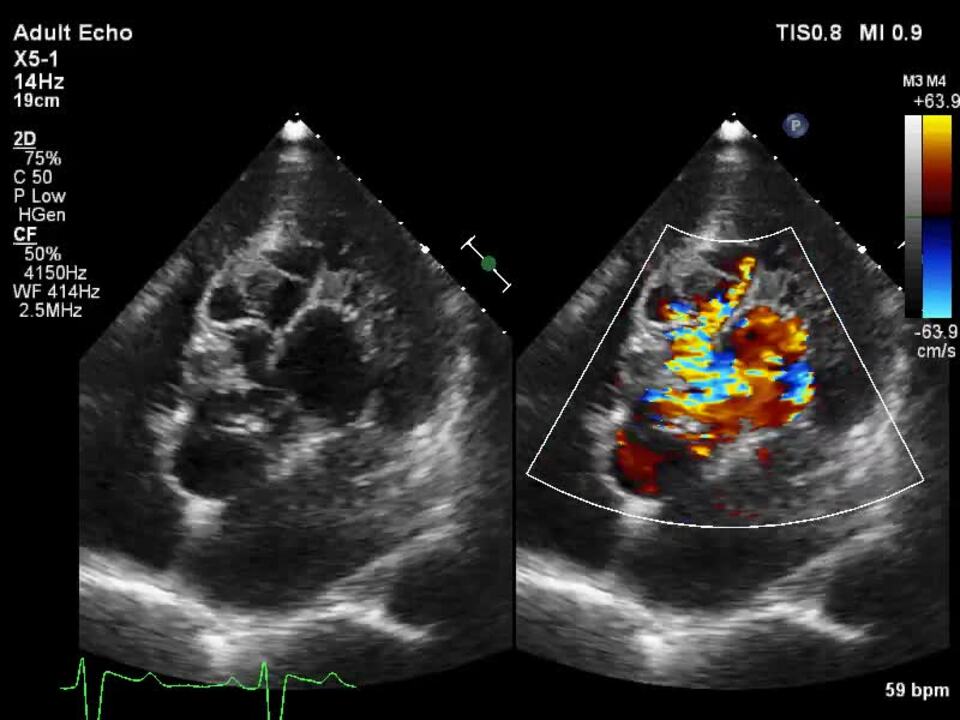 Acute Left Ventricular Systolic Dysfunction Following Device Closure of  Ruptured Sinus of Valsalva Aneurysm