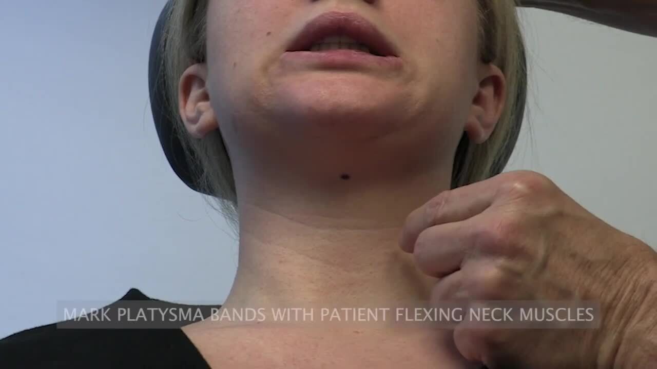 The MICRO-Lift: A Ligaments-Based Anatomic Technique for Lower Face and  Neck Rejuvenation Using Bipolar Radiofrequency.