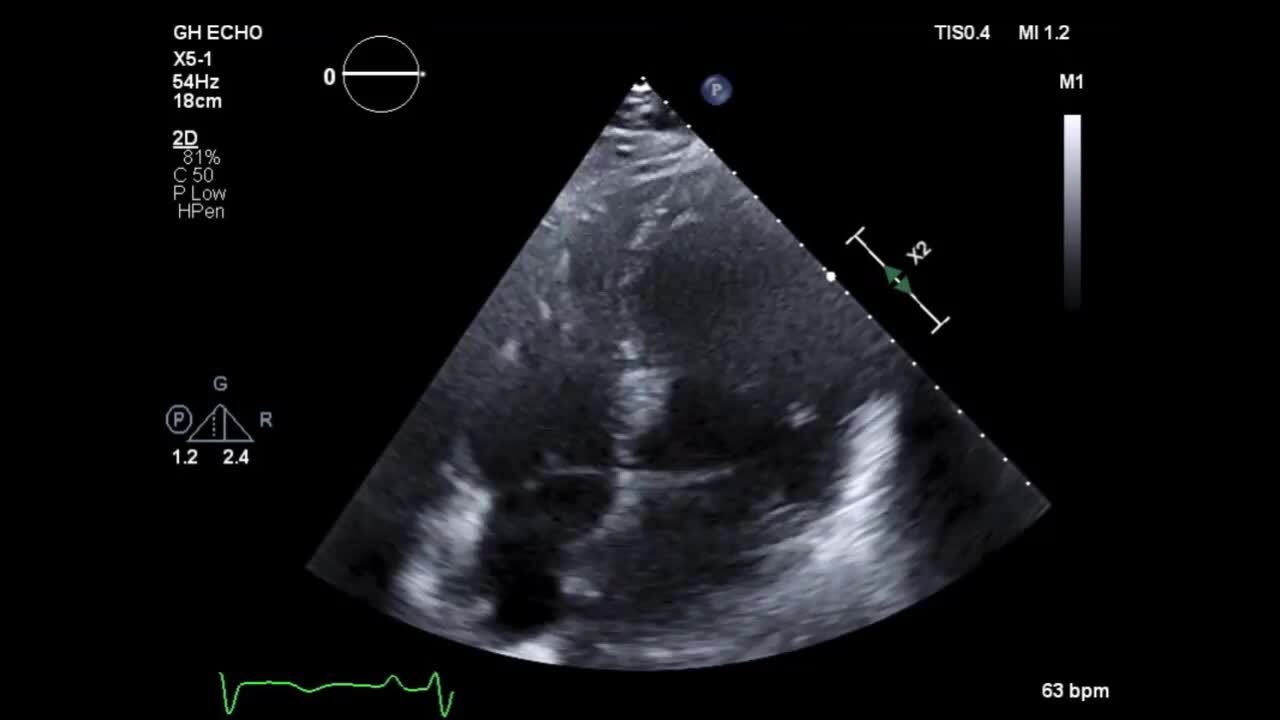 FULL TEXT - Mid-ventricular takotsubo: A case report - International  Journal of Case Reports and Images (IJCRI)