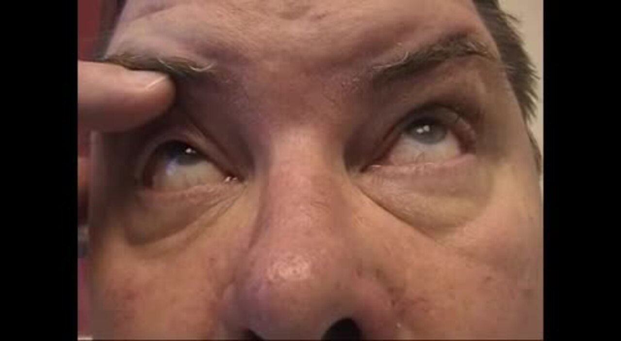 Ptosis, A Video Atlas of Neuromuscular Disorders