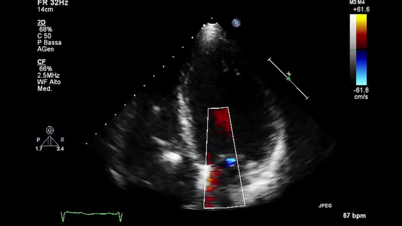 Three and two-dimensional cardiac mechanics by speckle tracking are  predictors of outcomes in chagas heart disease