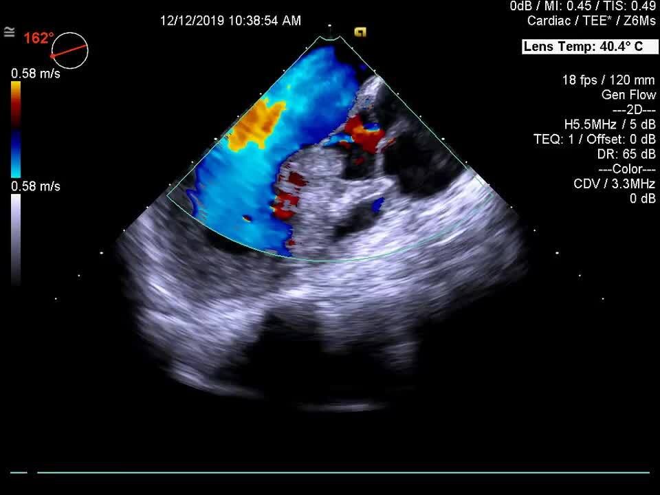 rare case of isolated accessory mitral tissue in an asymptomatic adult  female | Interdisciplinary CardioVascular and Thoracic Surgery | Oxford  Academic