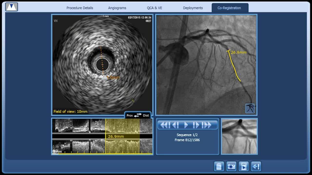 TCT-24. Combined Near-Infrared Spectroscopic and Intravascular Ultrasound  Assessment of Coronary Plaque Burden and Lipid Pools: Validation with  Histology