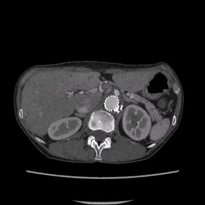 Repeated endovascular approaches achieve successful complete