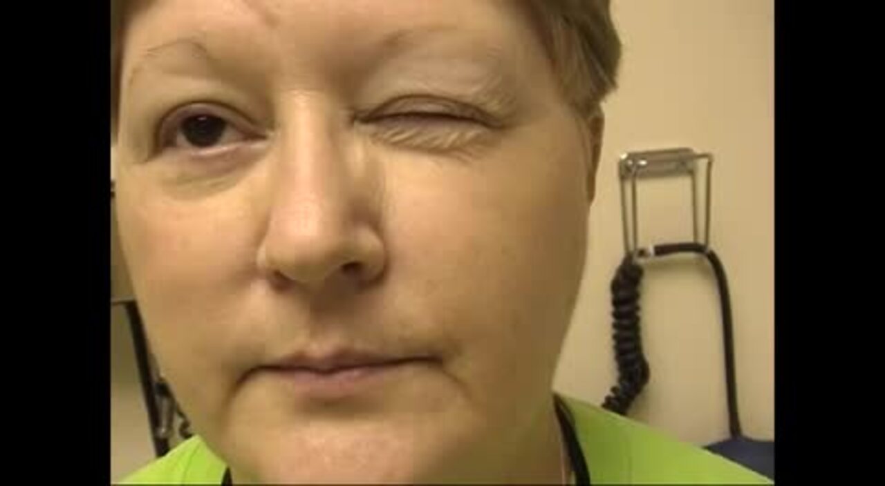 A) Small ptosis after breast feeding with a hands up test positif