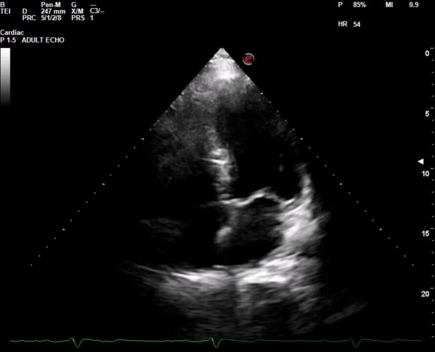 Uncommon type of tako-tsubo cardiomyopathy – Case report and current view -  ScienceDirect