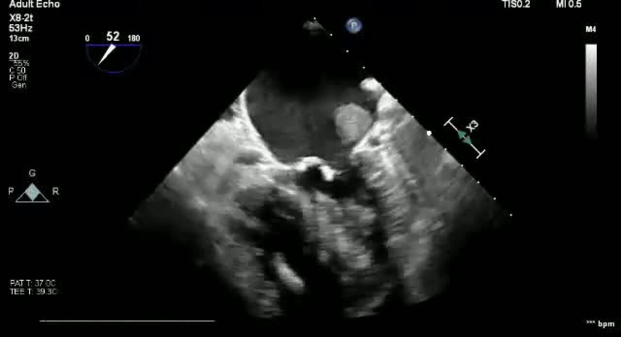 Predictors of Device-Related Thrombus Following Percutaneous Left