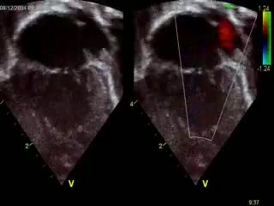 Hypoplastic left heart syndrome | The ESC Textbook of