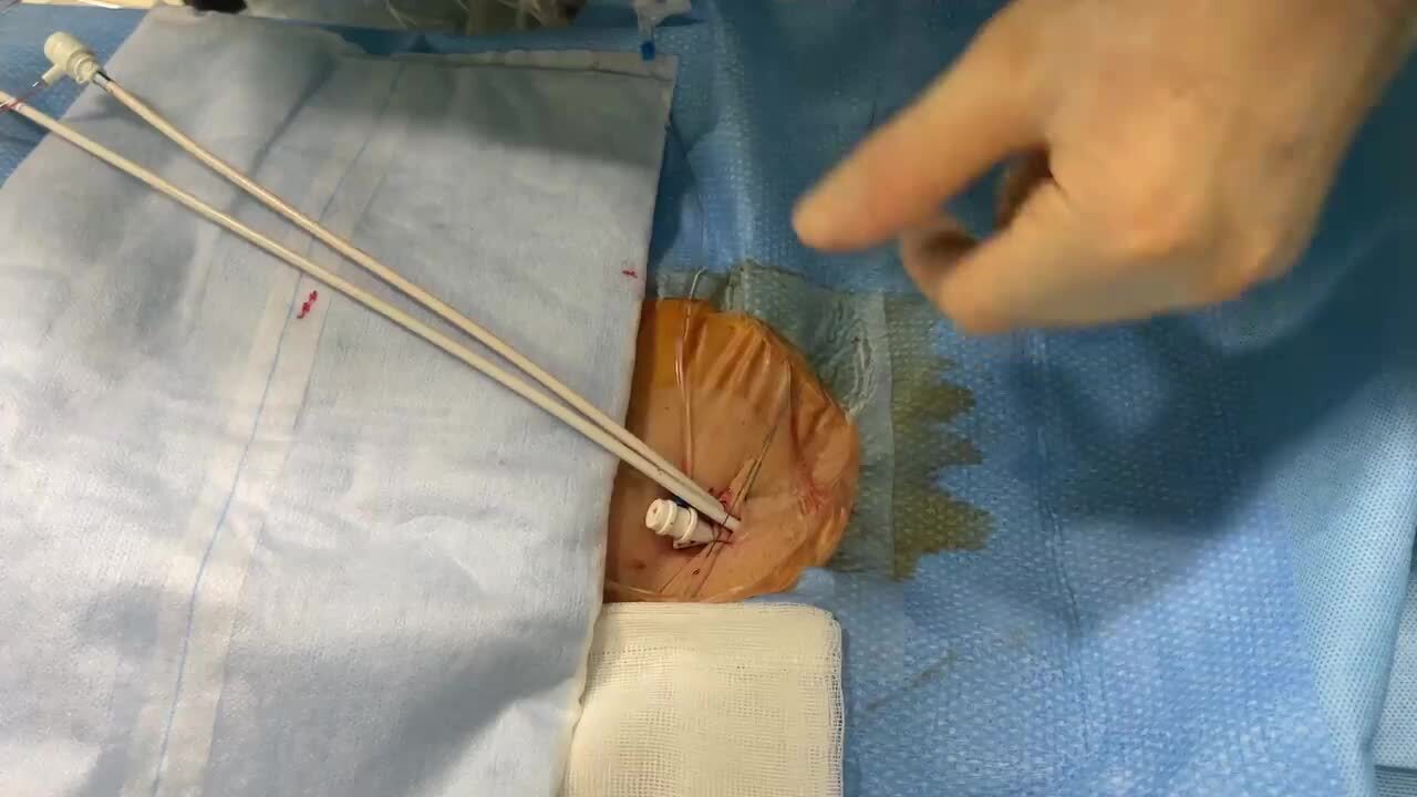 Tsuchiura's Stepwise Ablation Case Stud… Tsuchiura's Stepwise Ablation Case Stud… Tsuchiura's