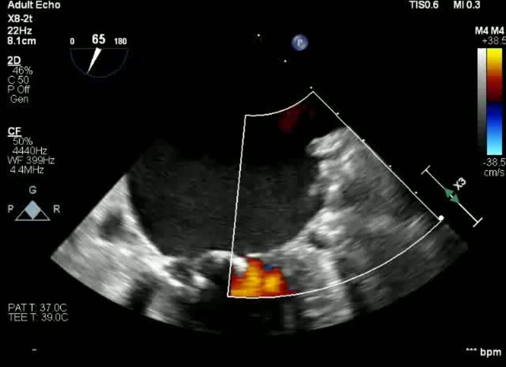 Predictors of Device-Related Thrombus Following Percutaneous Left