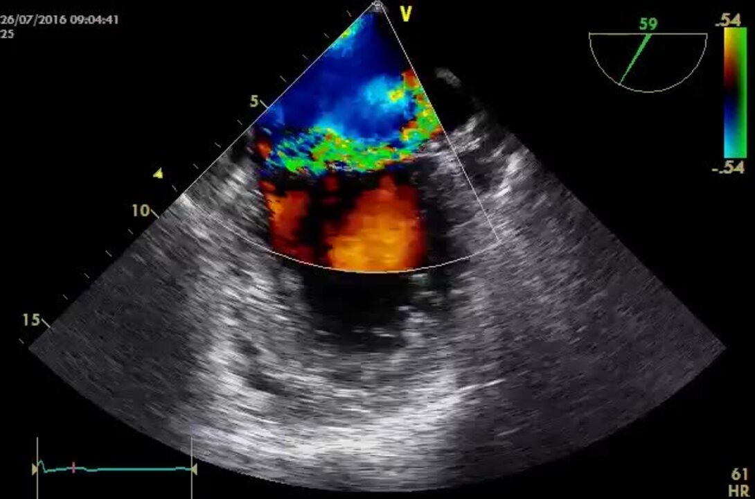 EACVI Textbook Of Echocardiography By Patrizio Lancellotti, 57% OFF