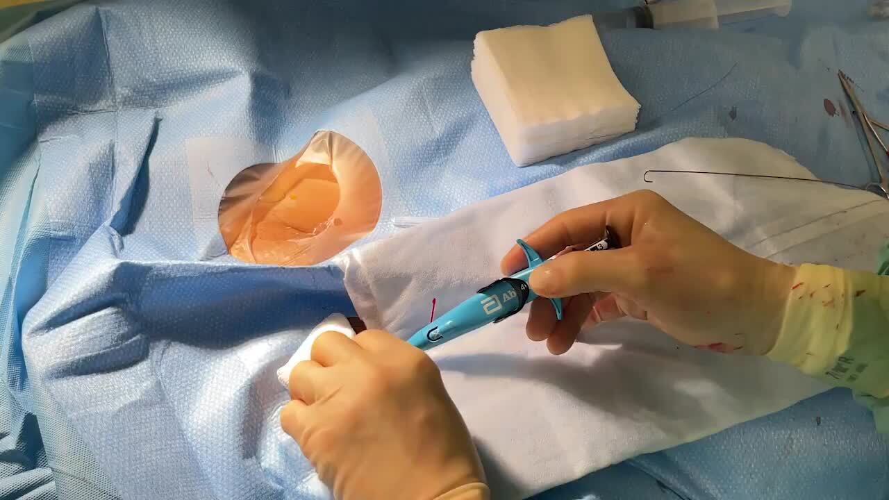 Venous vascular closure system vs. figure-of-eight suture