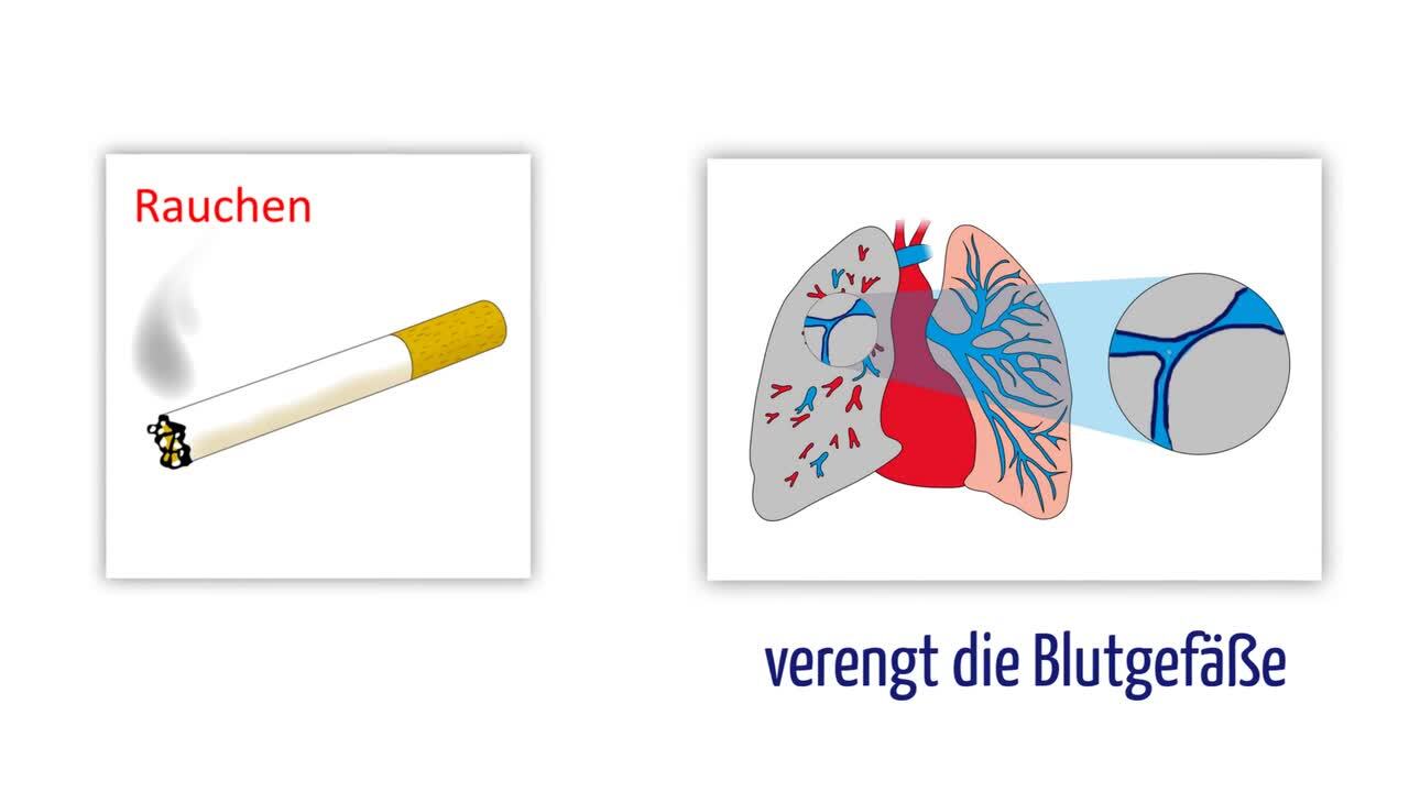 E-zigarette Nach Schlaganfall Über Schlaganfallprophylaxe bei  nichtvalvulärem Vorhofflimmern
