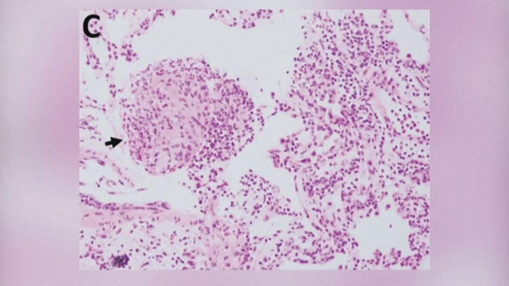 Lebender Wurm aus Gehirn von Frau herausoperiert