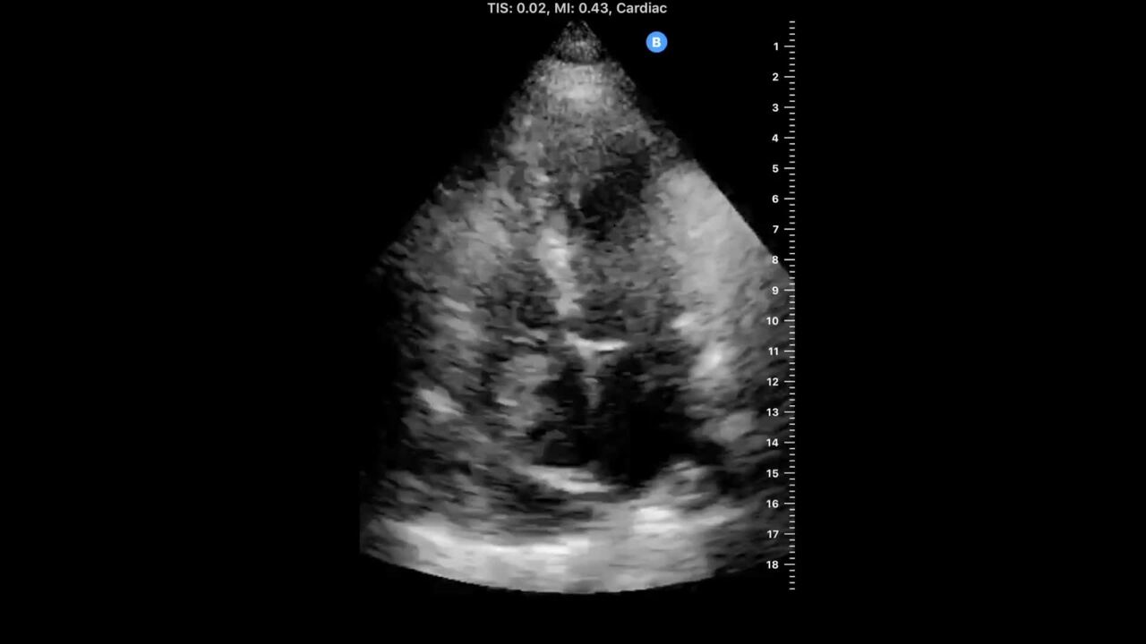 Dynamic right-to-left interatrial shunt may complicate