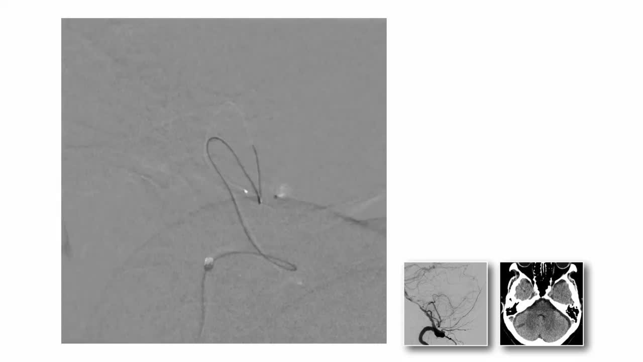 Coil embolization of distal vascular lesion using a 1.5 Fr