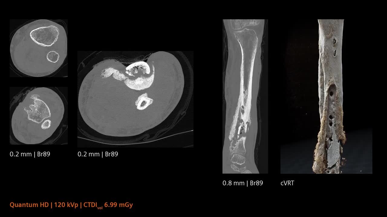 Photon-counting CT musculoskeletal imaging - Siemens