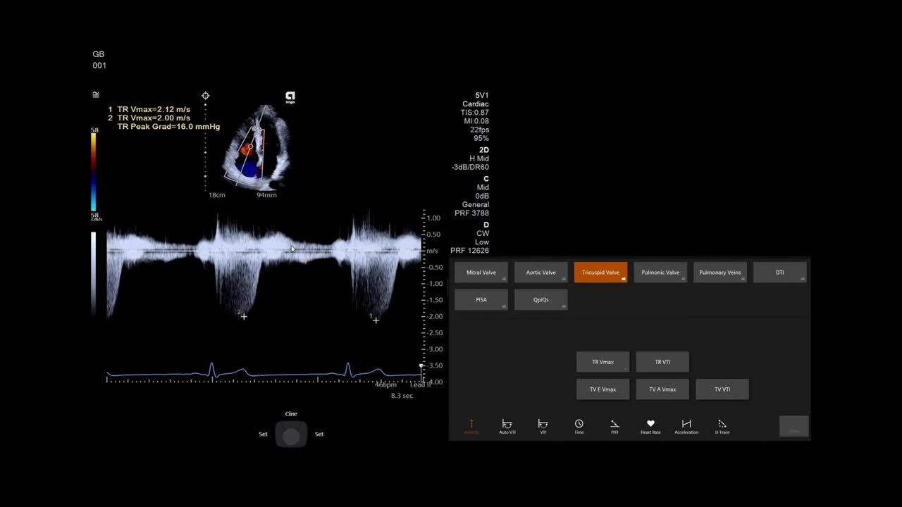 ACUSON Origin 心臓血管に特化した超音波画像診断機器 - Siemens