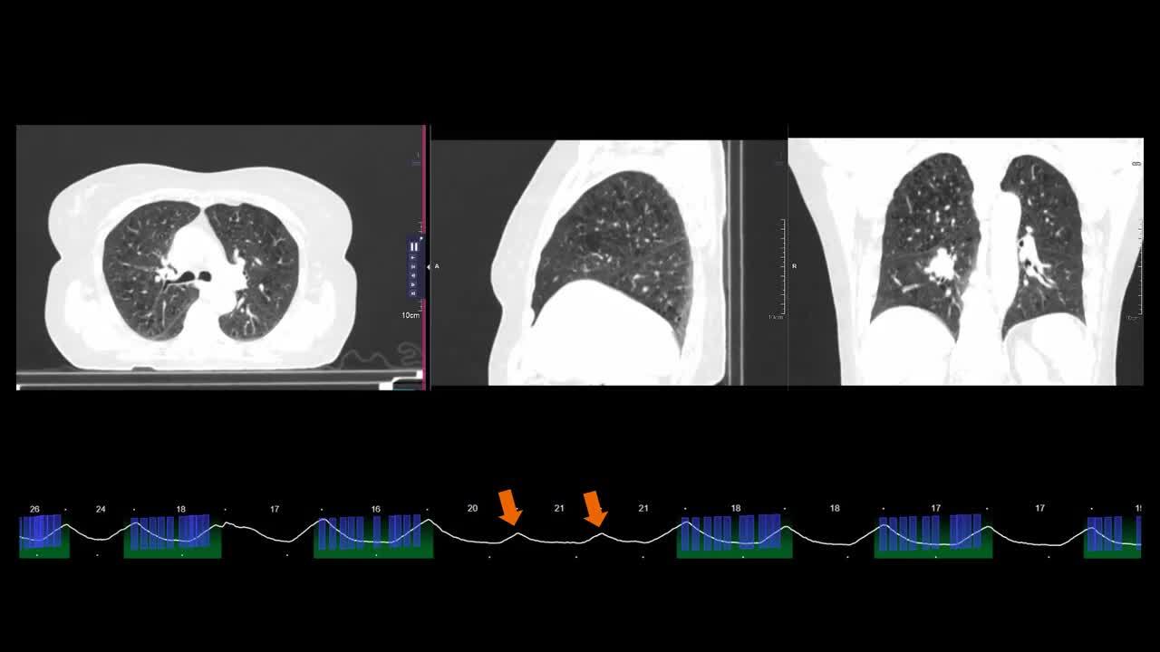 NAEOTOM Alpha.Prime for RT - Siemens Healthineers