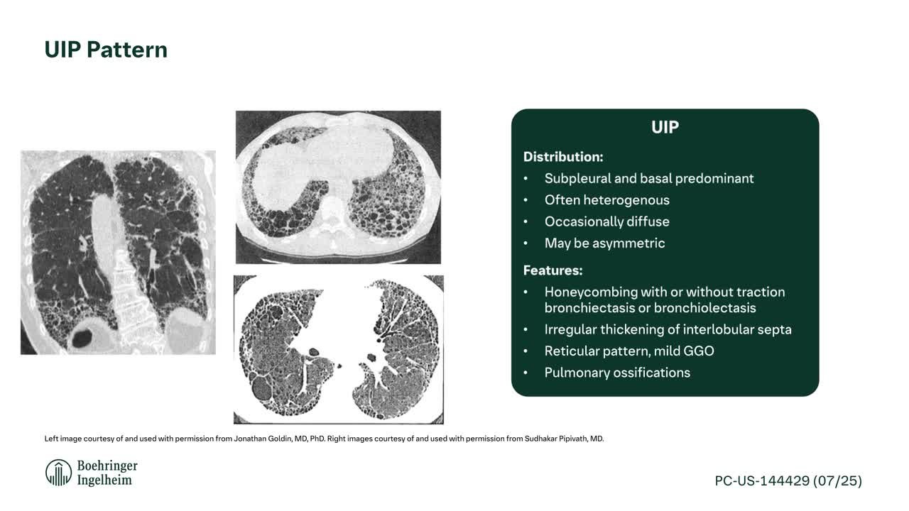 Interstice Optique What Is Interstitial Pneumonia