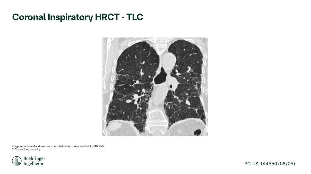 Fibrotic HP Coronal Inspiratory TLC Scan | ILD Radiology Rounds Fibrotic HP Coronal Inspiratory TLC Scan | ILD Radiology Rounds