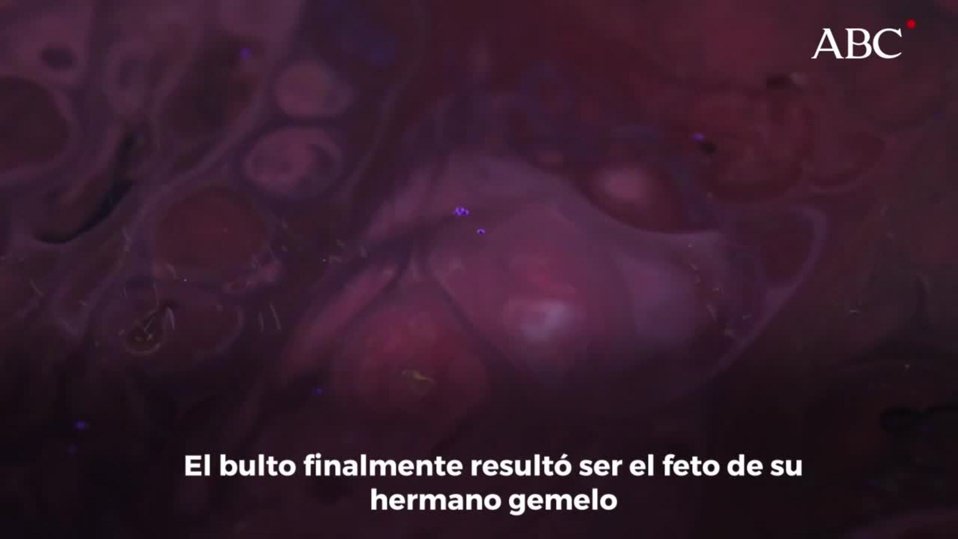 Una joven india descubre que el bulto de su abdomen es el feto malformado de su hermano gemelo