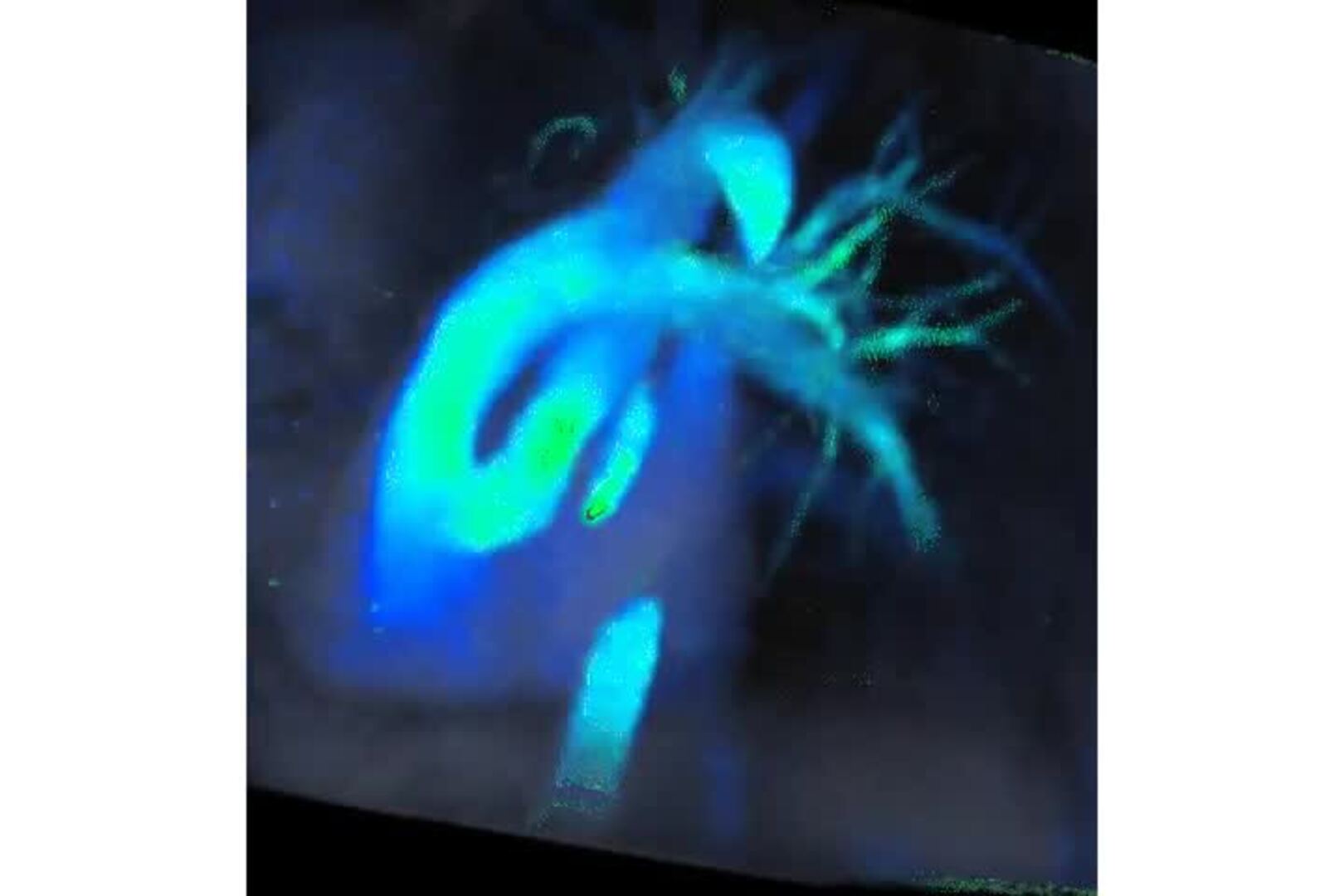 Ventajas del 4D FLOW: diagnósticos precisos gracias a la IA en las resonancias magnéticas del corazón