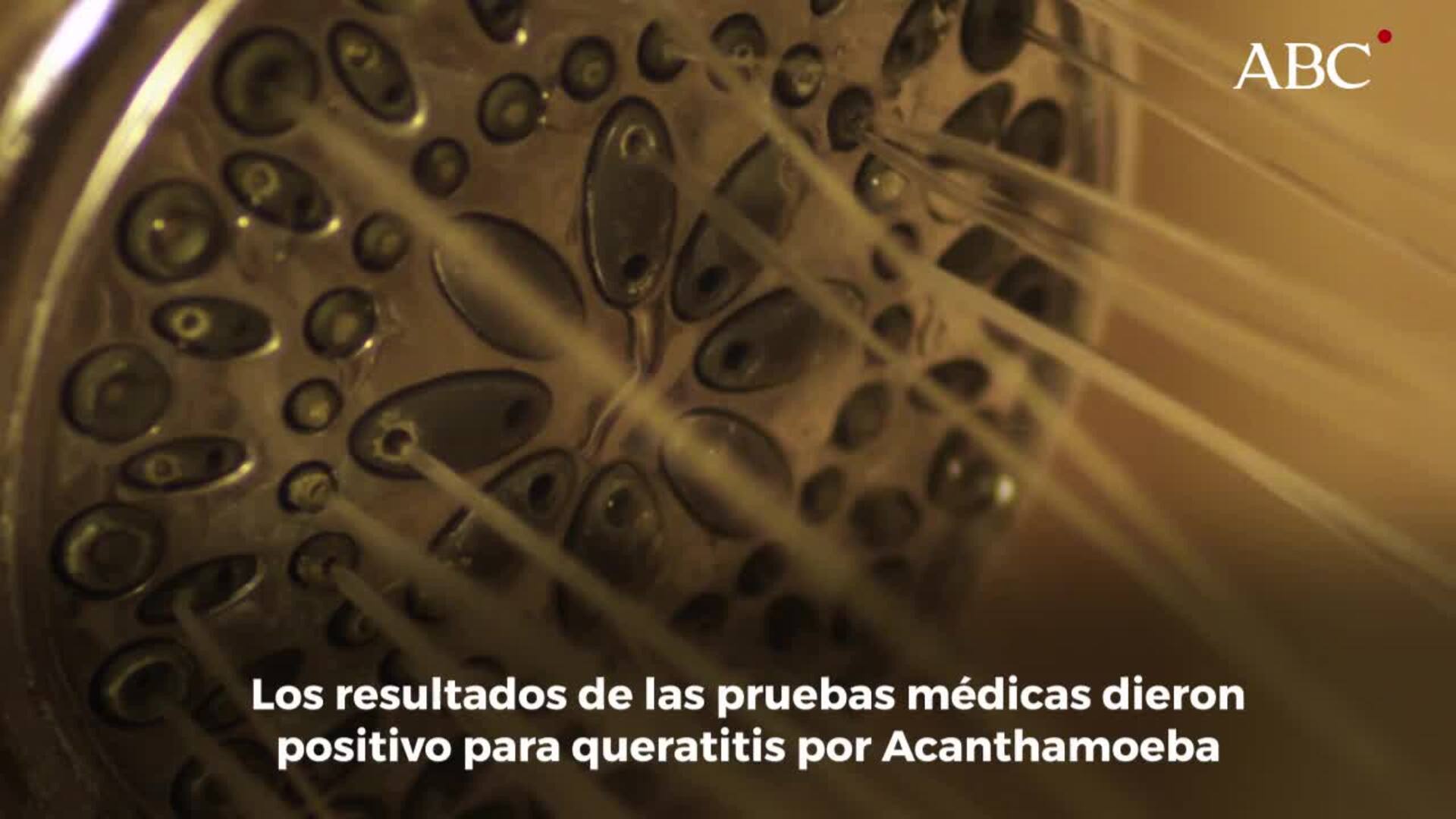 Un joven pierde la vista en un ojo por contraer un parásito a través de sus lentillas