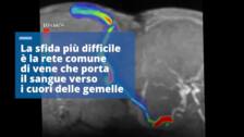 Operación sin precedentes en Italia: unas gemelas unidas por la cabeza, separadas en Roma