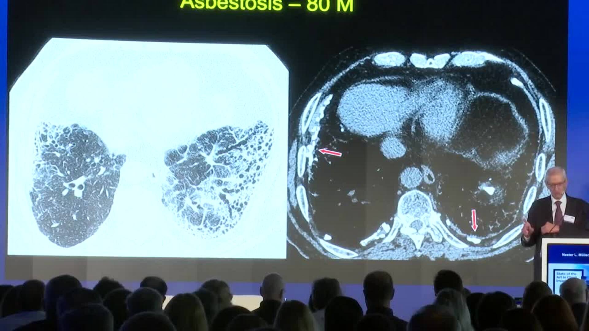 Árbol de los deseos para concienciar sobre la Fibrosis Pulmonar Idiopática