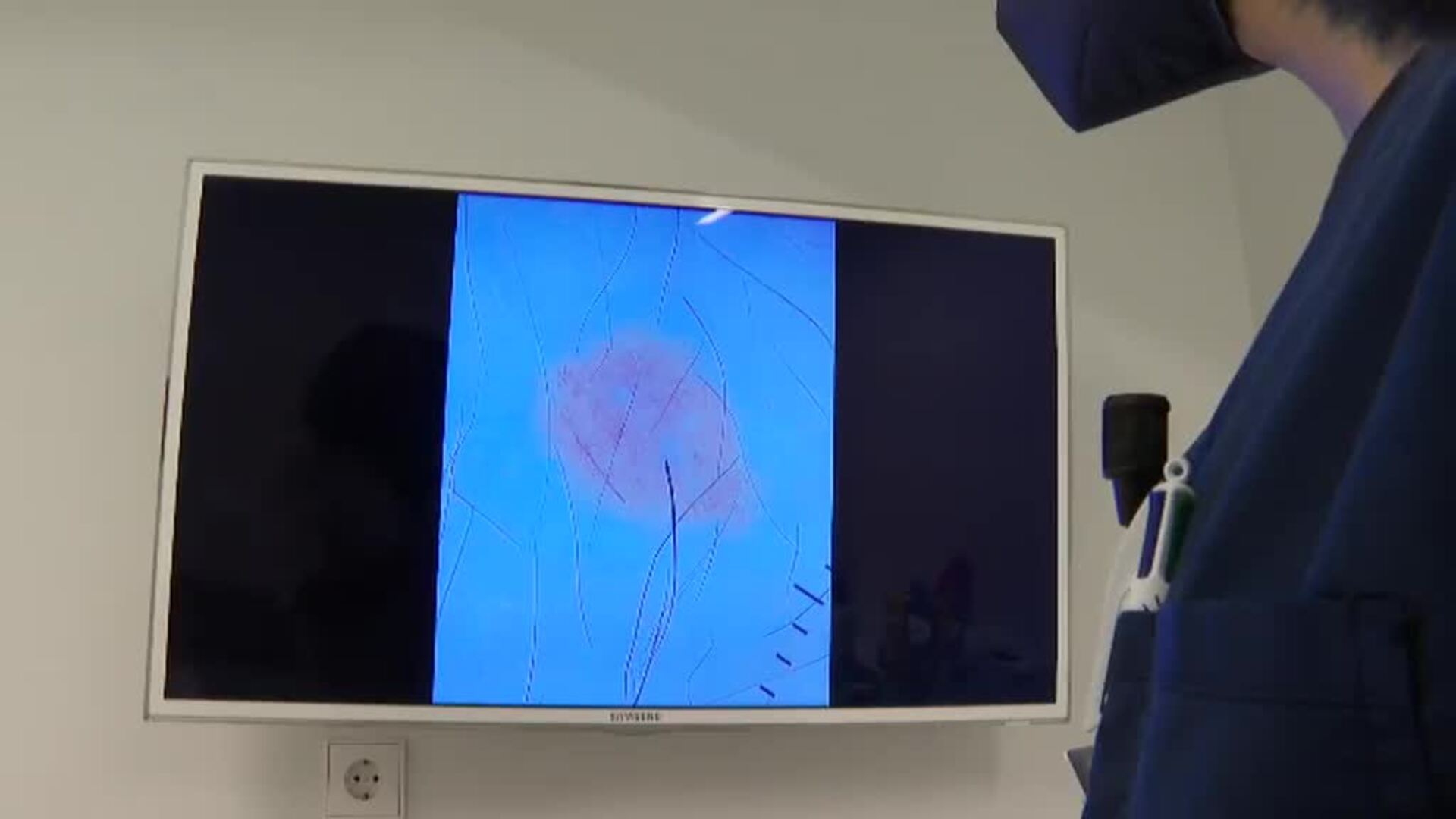Protección solar cada hora y media y revisión anual de los lunares, claves de la prevención