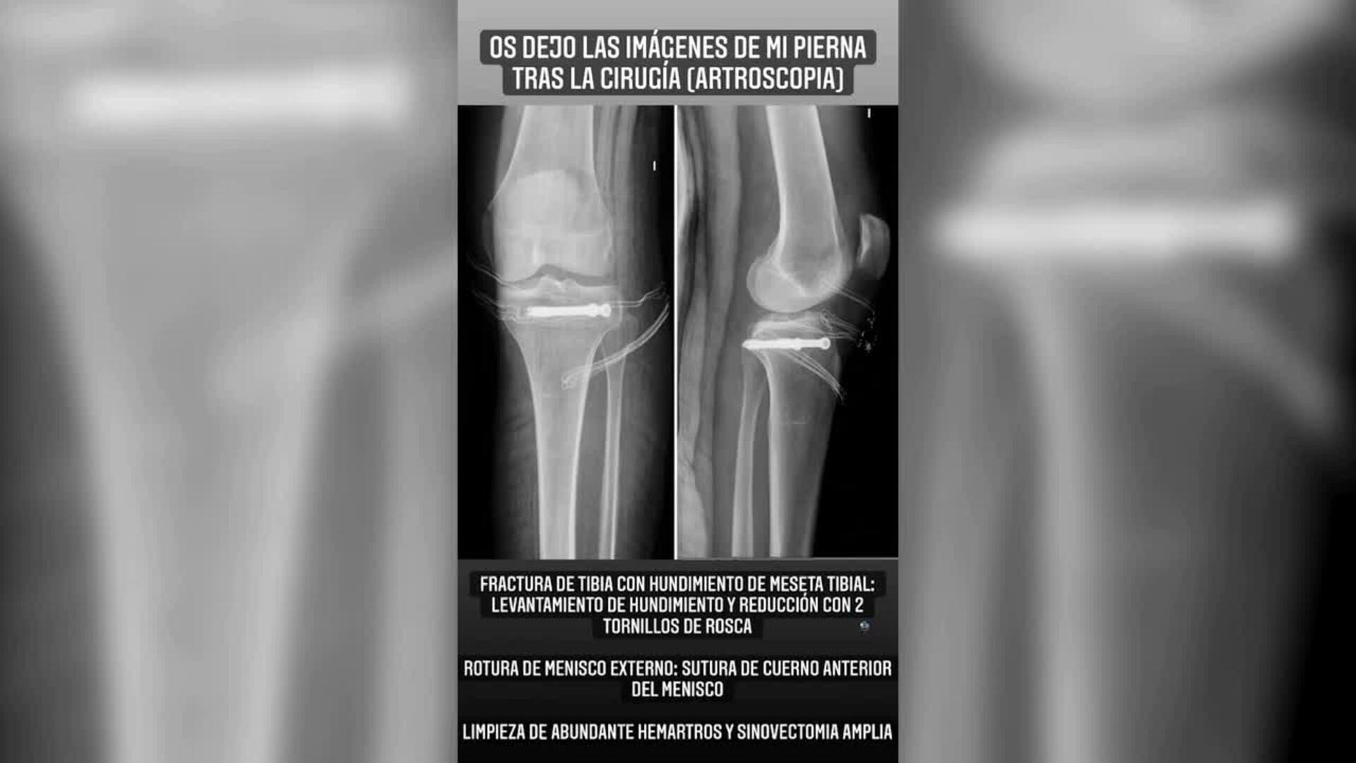 Carla Barber comparte imágenes de su operación tras fracturarse la tibia