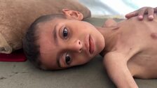 Decenas de miles de niños en Gaza padecen malnutrición
