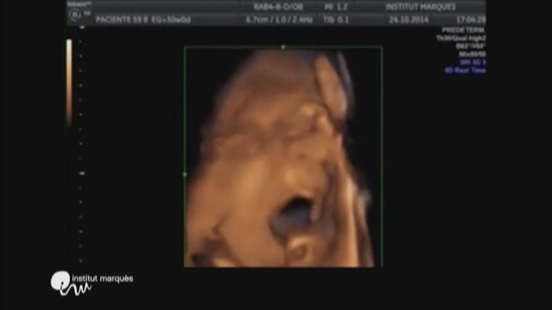 España supera en un 10% el nivel de cesáreas que recomienda la OMS