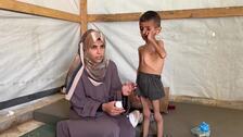 El niño Osama al Raqab de 5 años sufre malnutrición en Gaza