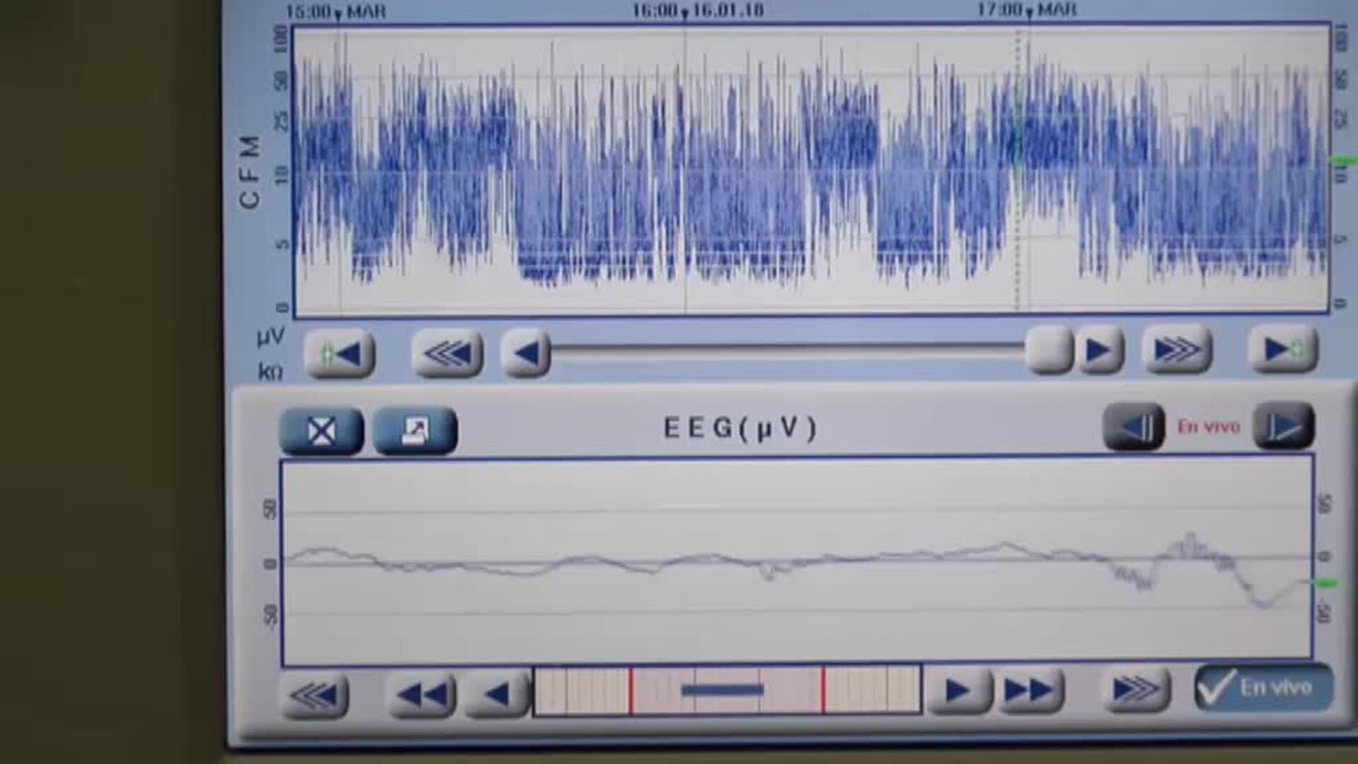 Naiara, la bebé salvada gracias a un trasplante pionero en el mundo