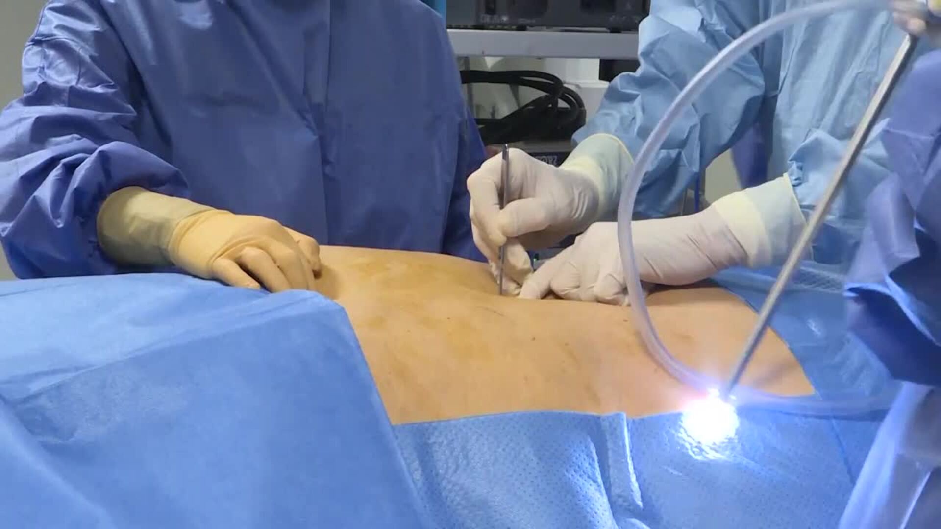 Un hombre con obesidad extrema se somete a un bypass para perder unos 200 kg