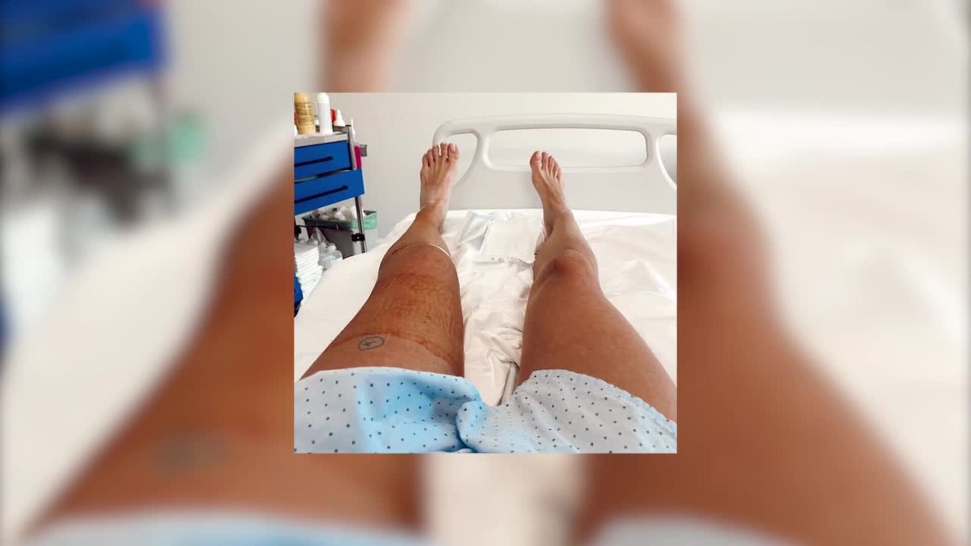 Carla Barber y su odisea para ducharse tras la fractura de tibia