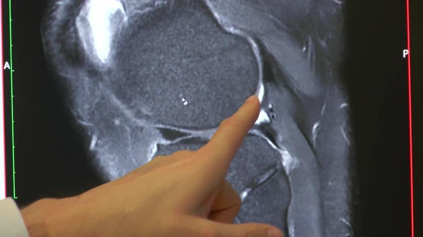Gonarthrose : l'IRM dans l'interligne | Le Quotidien du Médecin