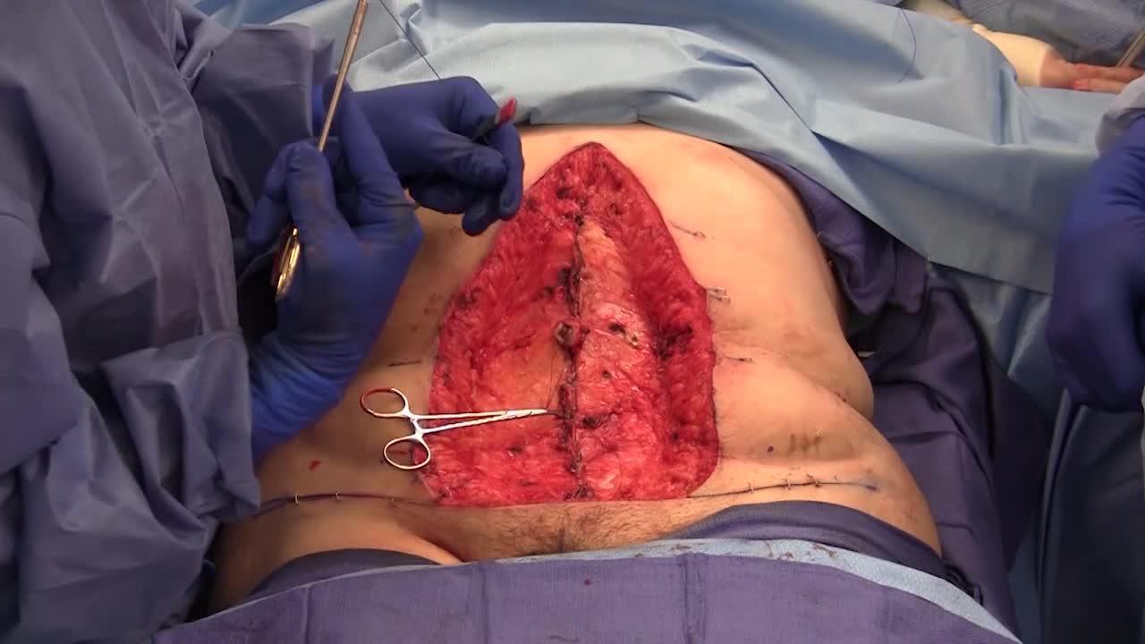 A 30-year-old female underwent a lower body lift with vertical