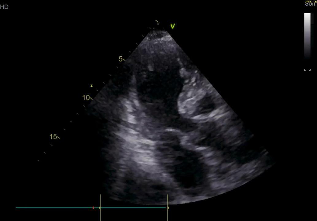 FULL TEXT - Mid-ventricular takotsubo: A case report - International  Journal of Case Reports and Images (IJCRI)