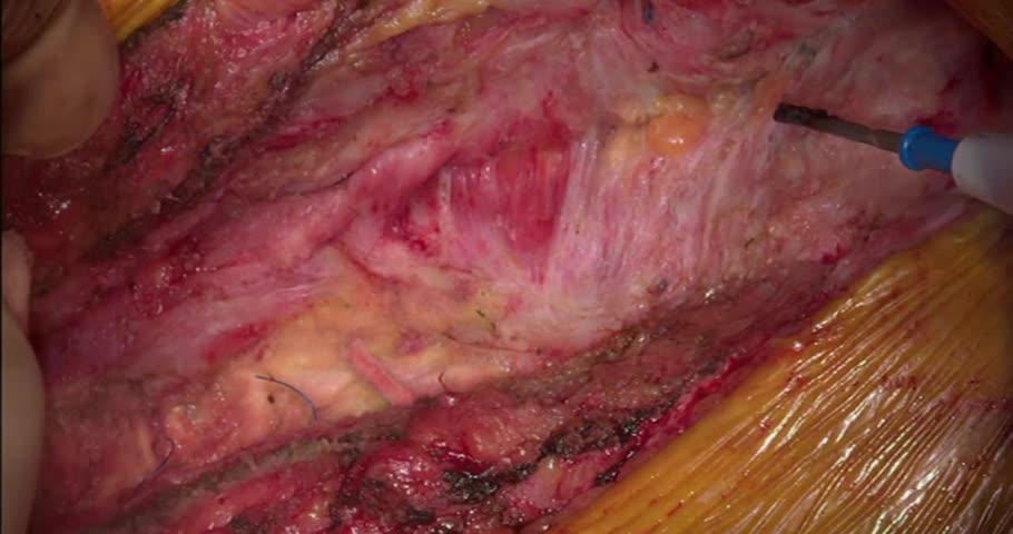 Reoperation 7 years after sternal reconstruction with a porcine