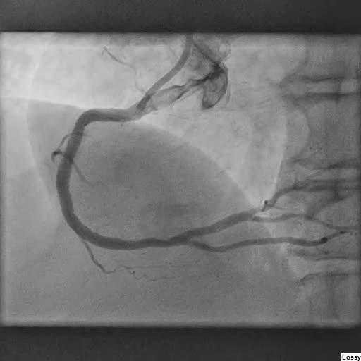 Retention of Bovie scratch pad radio-opaque marker during VATS Pleurodesis:  case report, Journal of Cardiothoracic Surgery