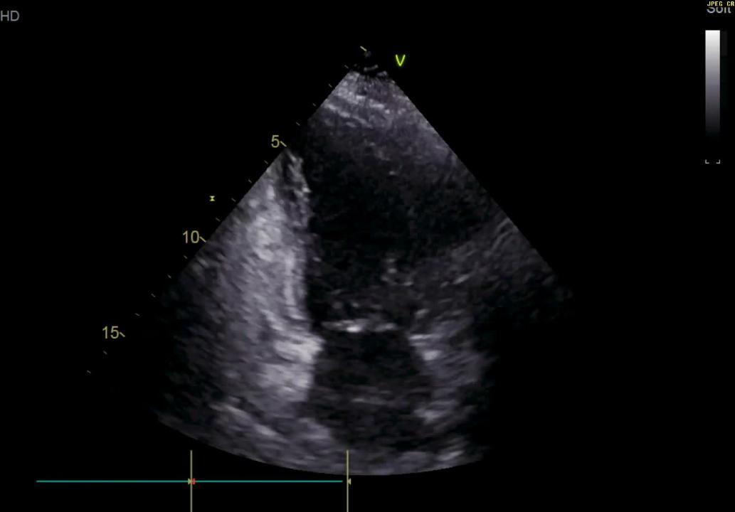 FULL TEXT - Mid-ventricular takotsubo: A case report - International  Journal of Case Reports and Images (IJCRI)