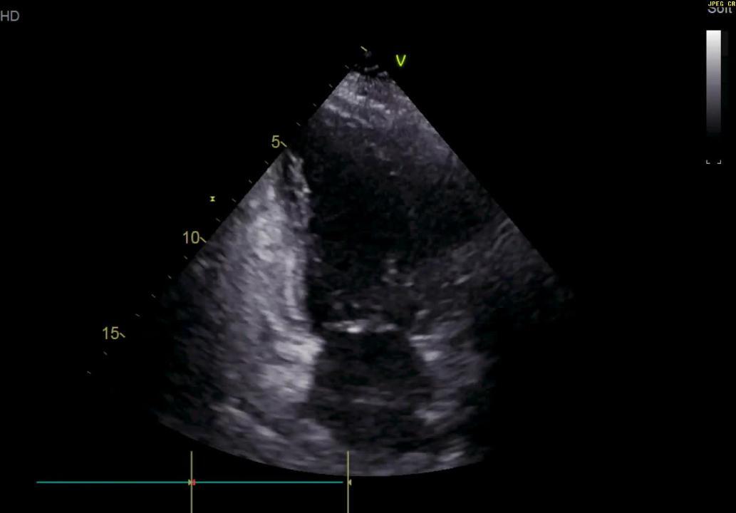 Uncommon type of tako-tsubo cardiomyopathy – Case report and current view -  ScienceDirect