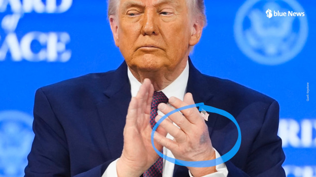 D’où vient l’ecchymose à la main de Donald Trump ?