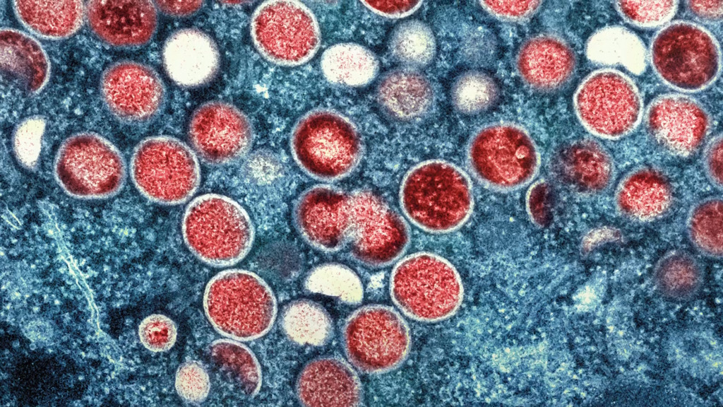 WHO ruft wegen Mpox weltweite Notlage aus